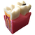 Демонстрационная модель кариеса зубов paro®